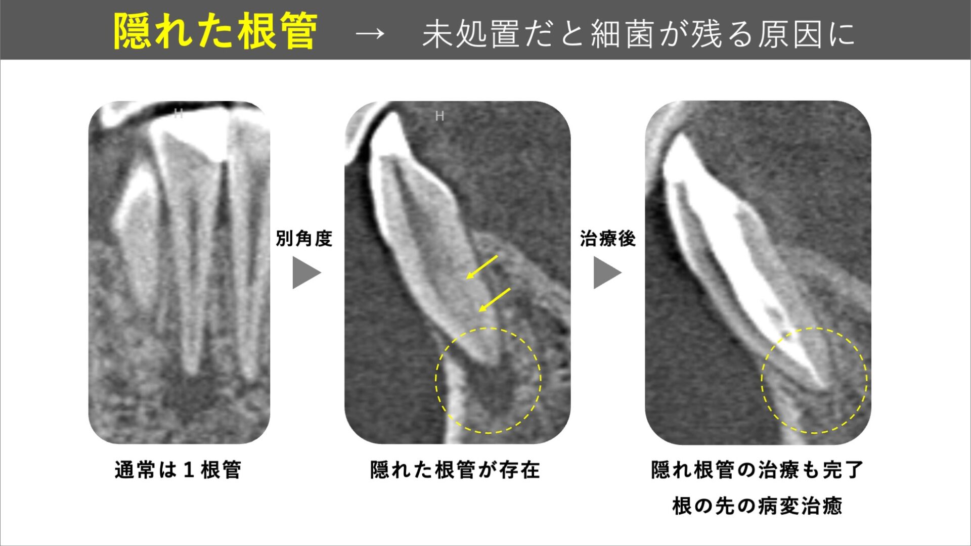 image_tooltip 見逃された根管がある