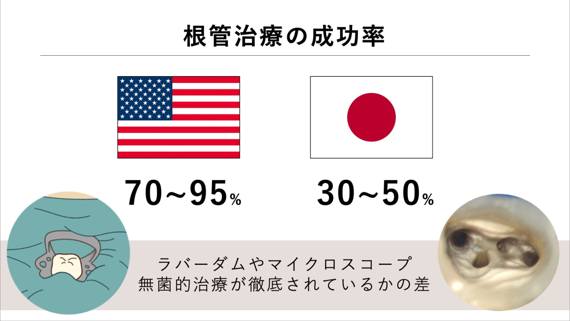 image_tooltip 1回目の治療の質が歯の寿命を左右する
