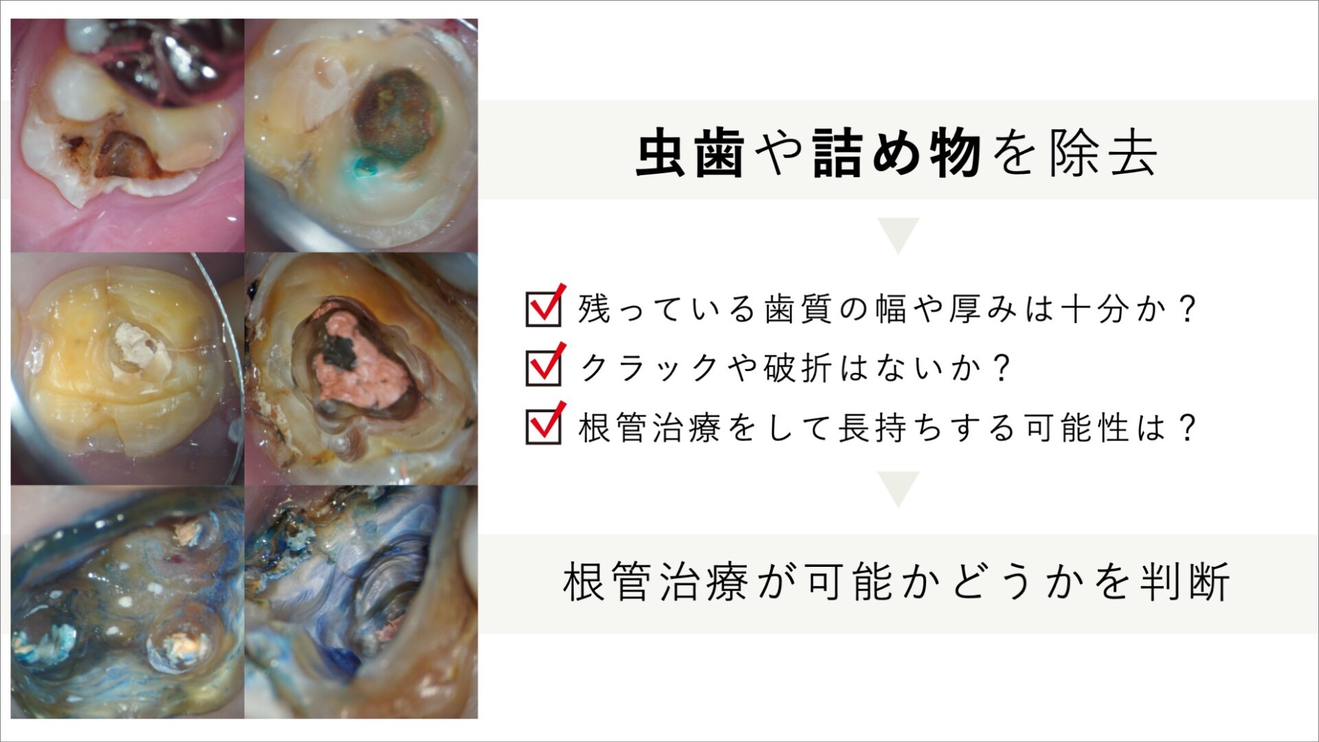 image_tooltip 歯質があまり残っていない