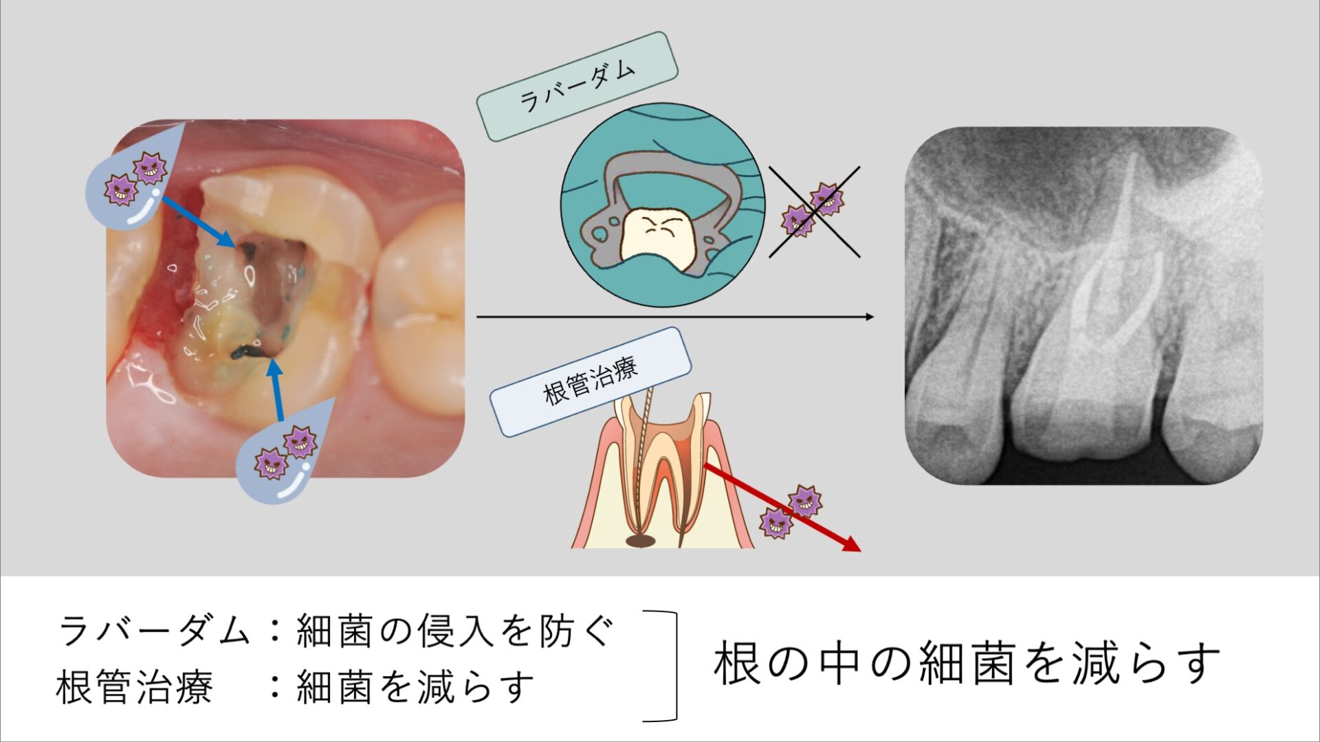 唾液に含まれる細菌の侵入を防ぐ