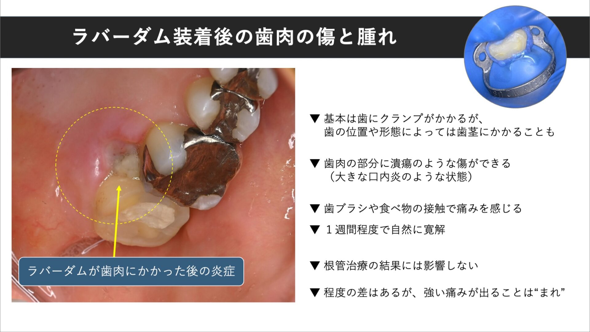 クランプで歯茎が痛んだり傷がついたりすることはありますか