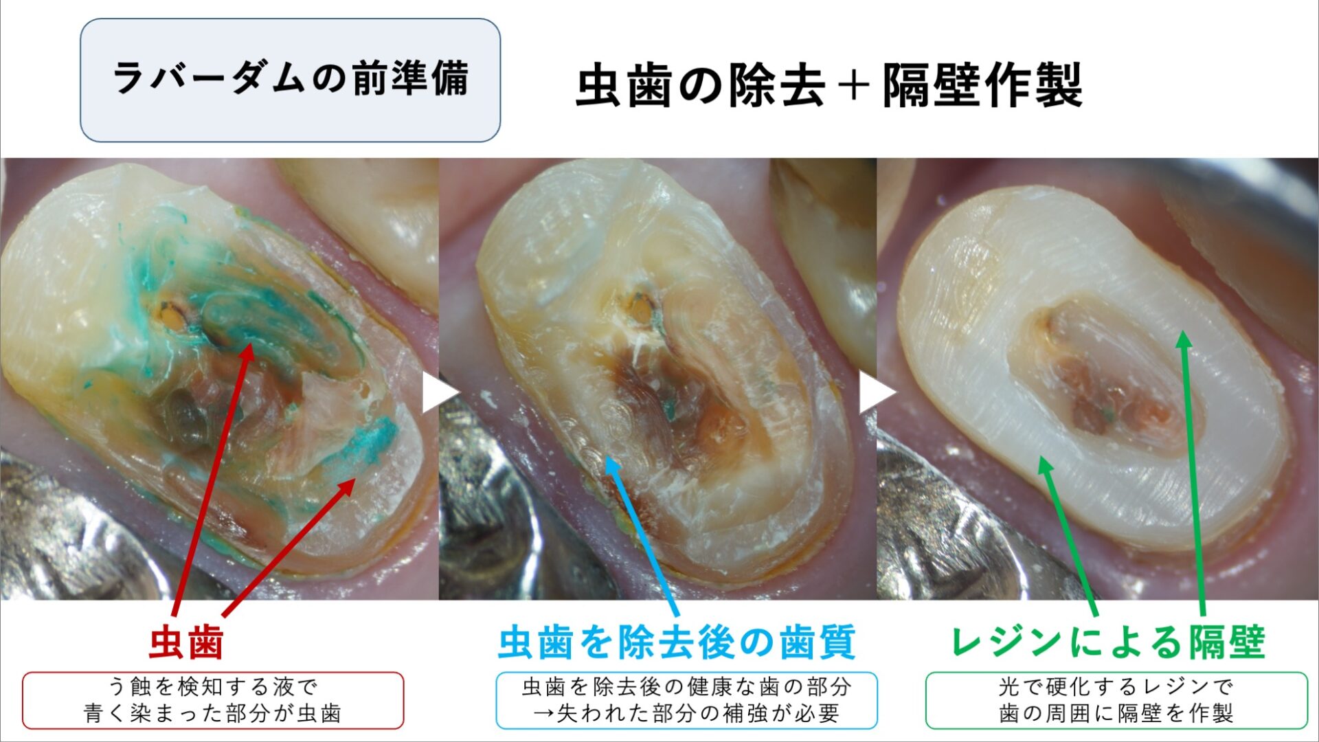 歯の状態を確認し、必要に応じて隔壁をつくる