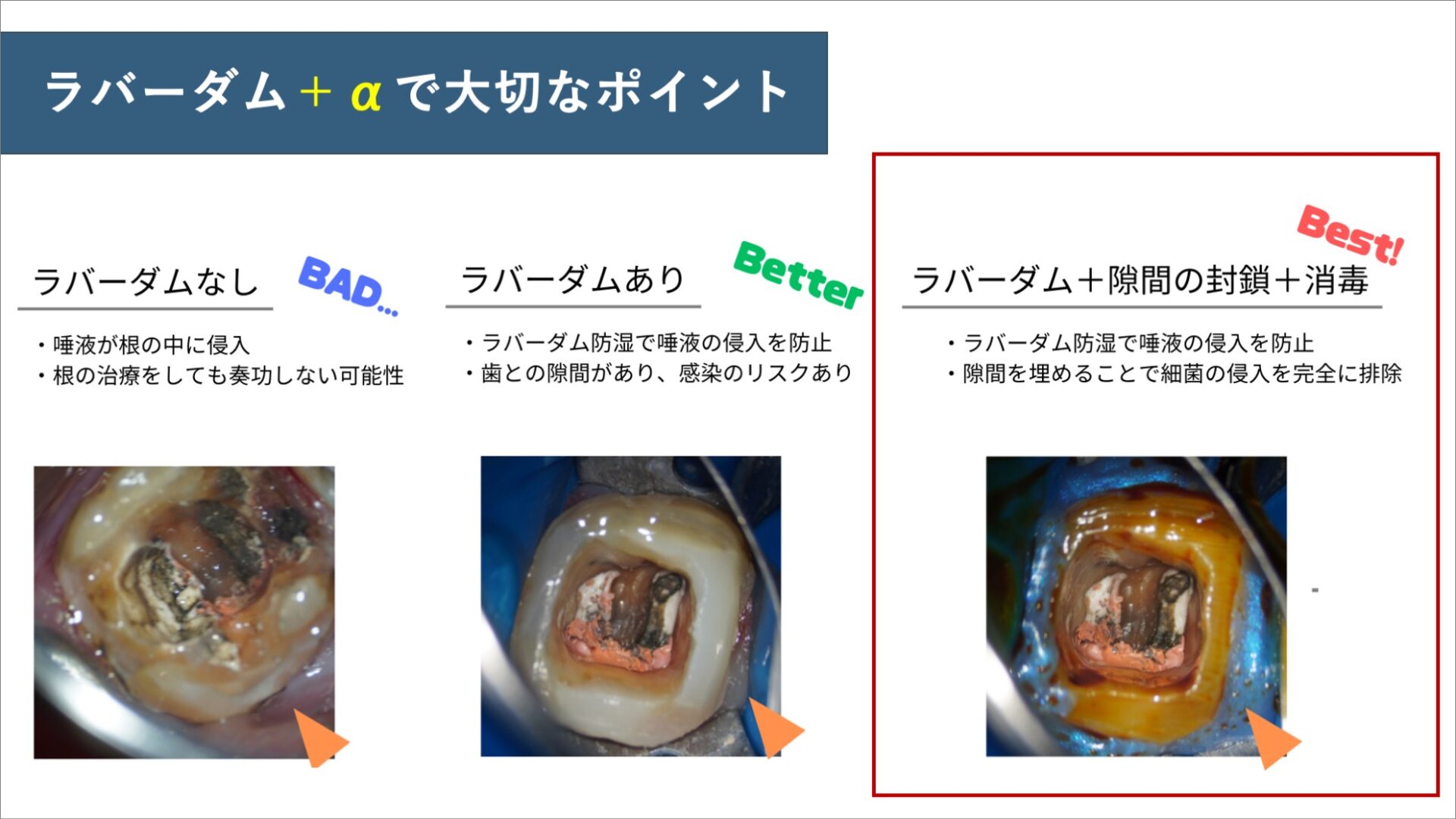 フレームでシートを広げ、歯との隙間を封鎖する