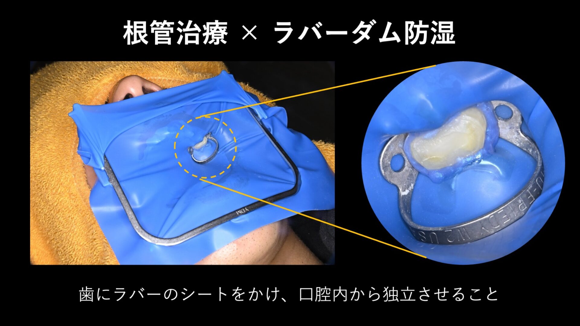 ラバーダムとは｜根管治療で歯を唾液から隔離するゴムのシート