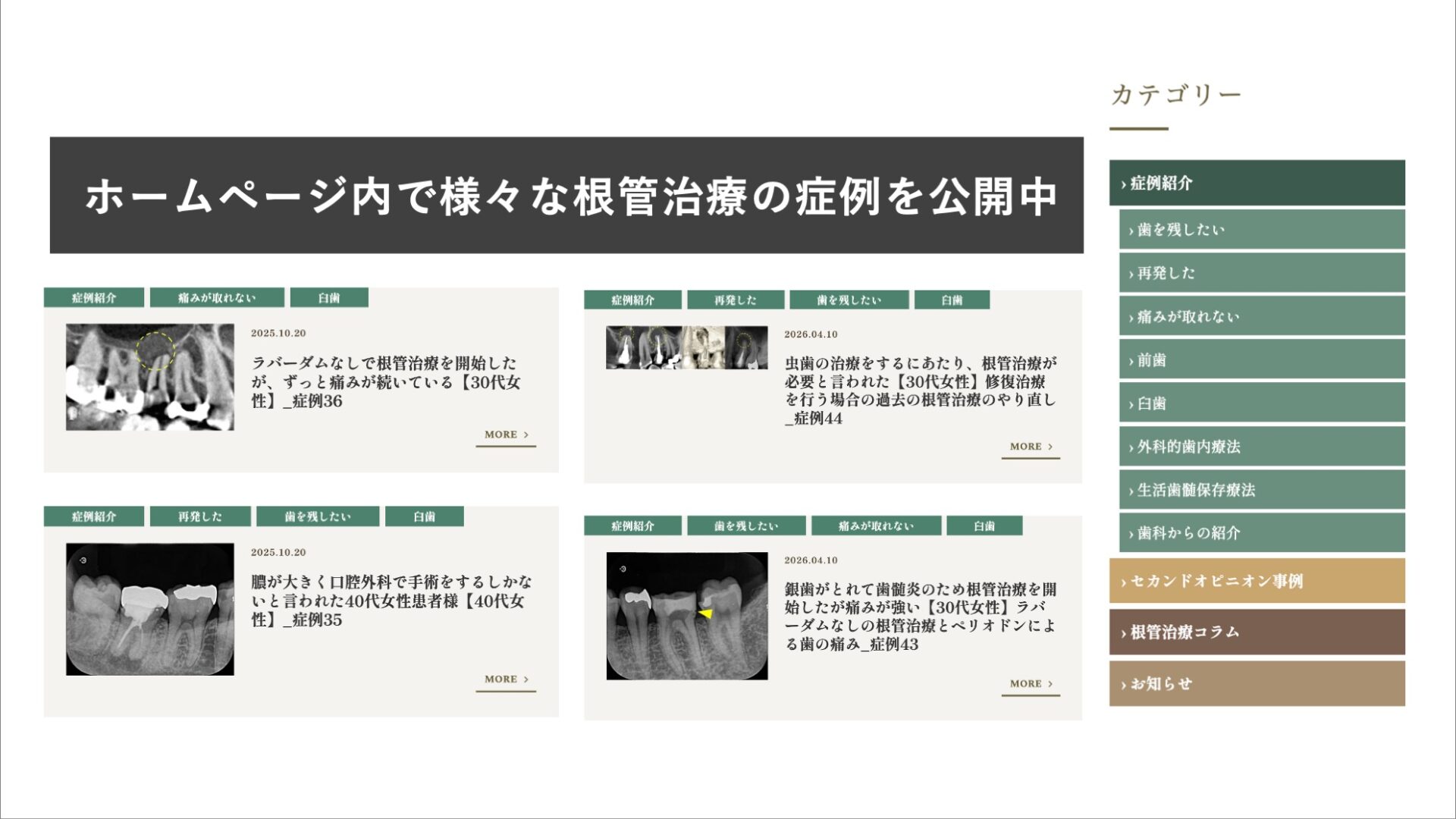 ホームページ内で様々な根管治療の症例を公開中