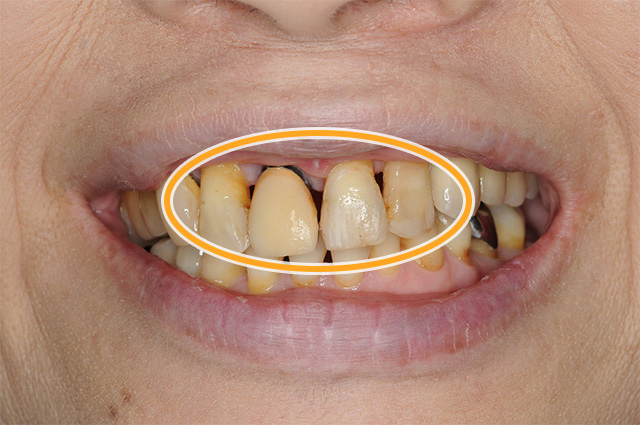審美歯科の症例1治療前