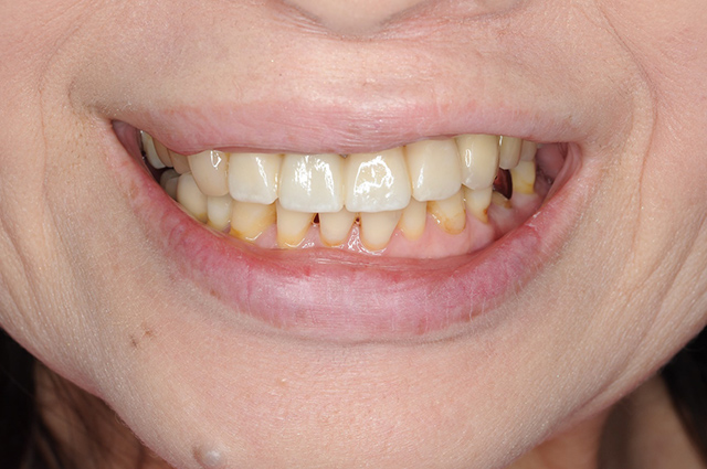 審美歯科の症例1治療後