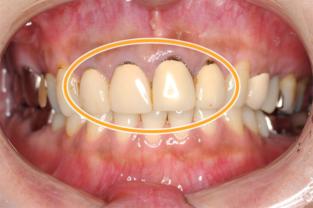 審美歯科症例2治療前