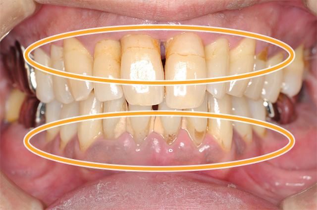歯周病症例1治療前
