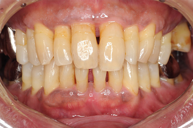 歯周病症例1治療後