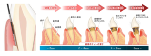 periodontal probing