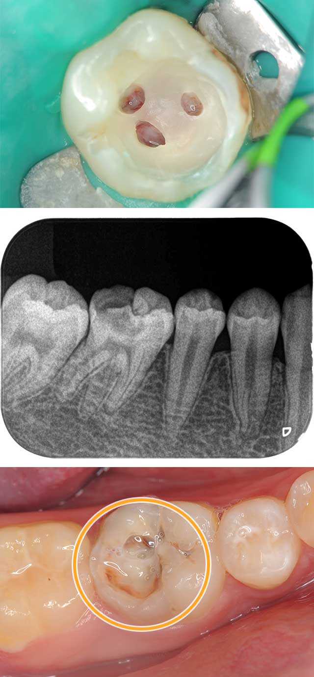 大きなむし歯で神経を保存した治療例20代女性治療前