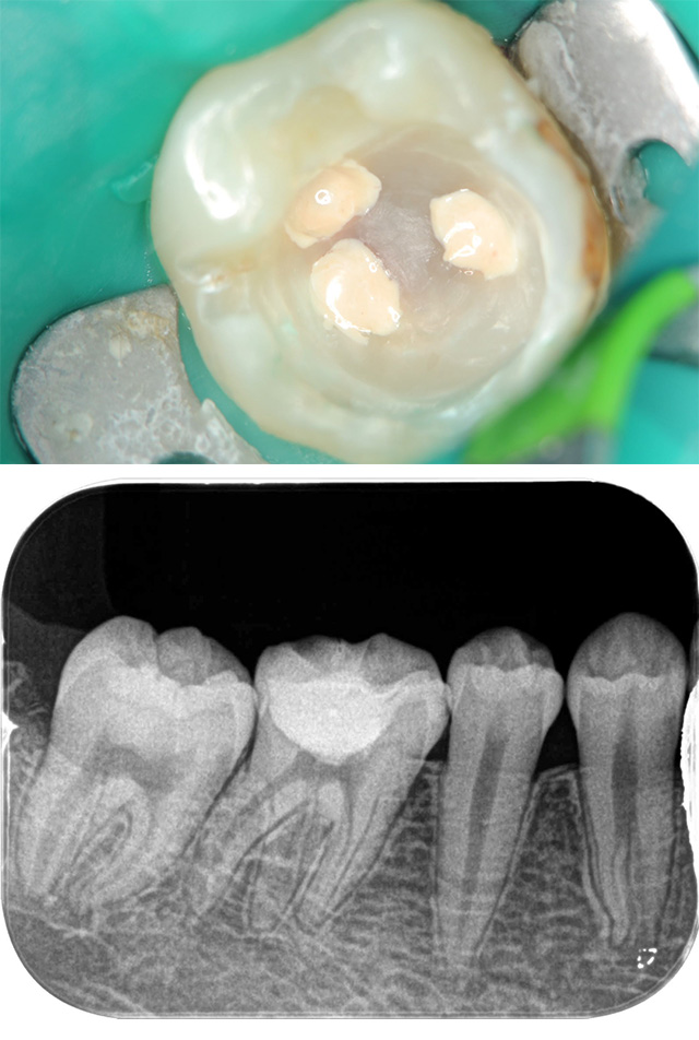 大きなむし歯で神経を保存した治療例20代女性治療後