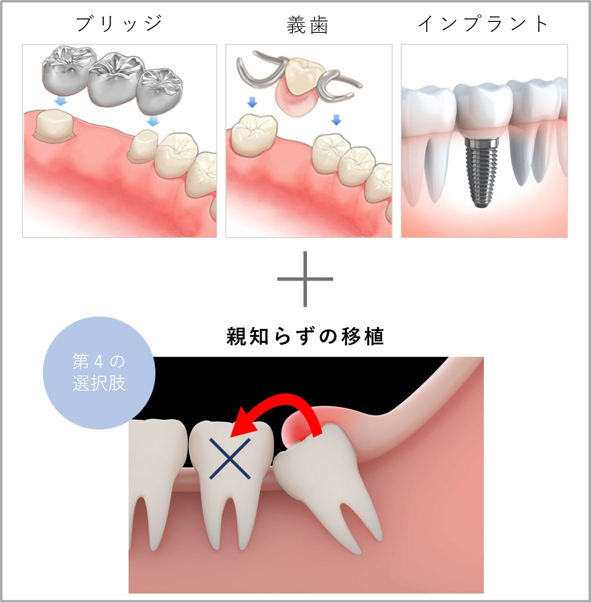 歯の移植イメージ