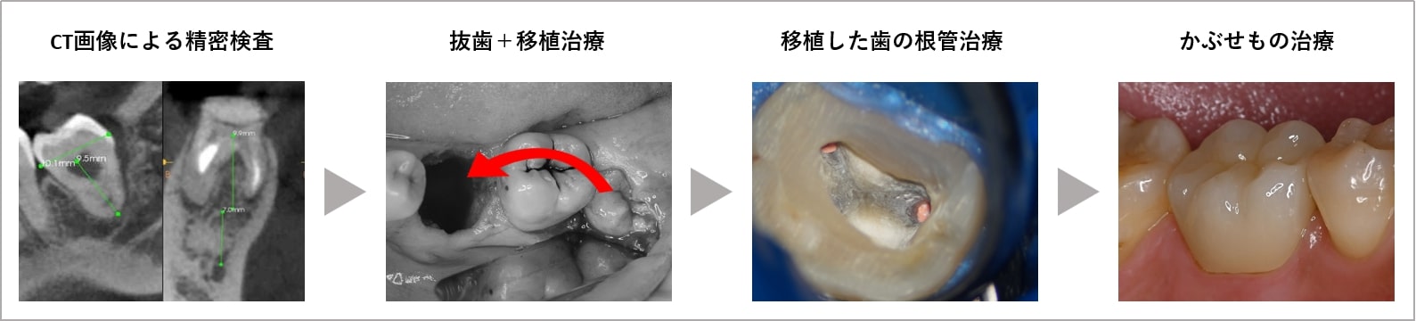 歯の移植治療の流れ