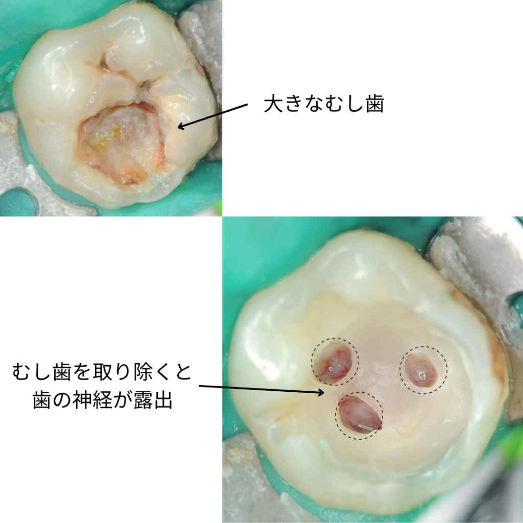 歯の神経を抜く治療とは!?歯の神経治療のメリットとデメリット|大阪府豊中市の歯医者・歯科|【公式】髙井歯科クリニック