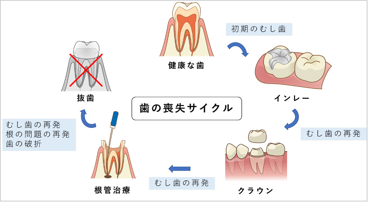 歯の喪失サイクル