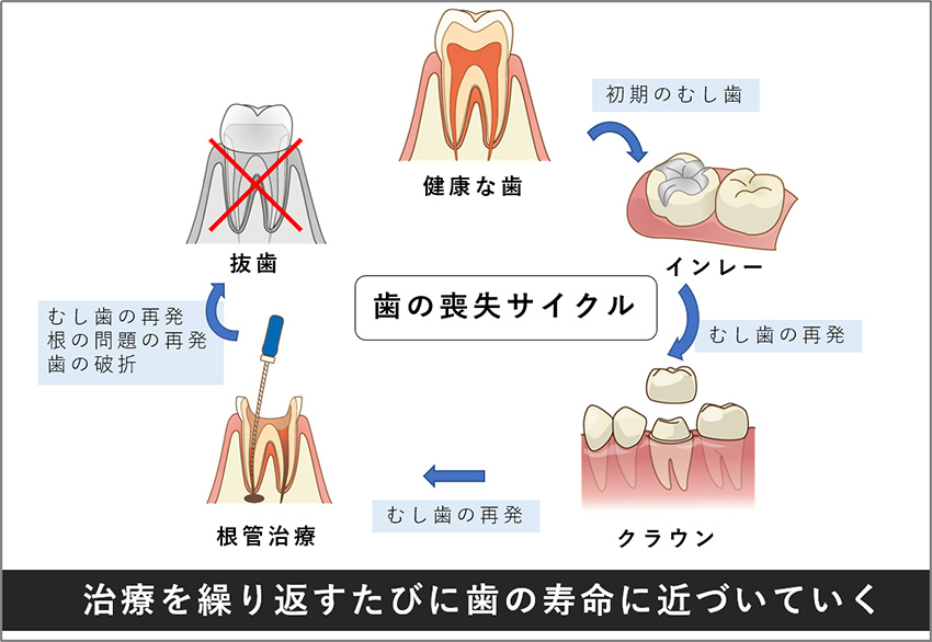 歯は治療すればするほど寿命に近づいていきます