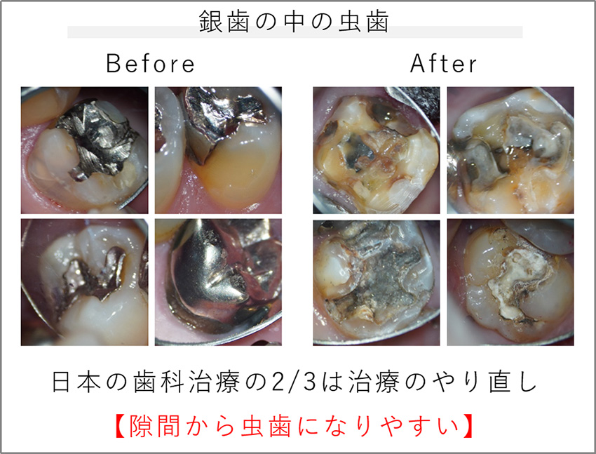 銀歯は虫歯になりやすい？