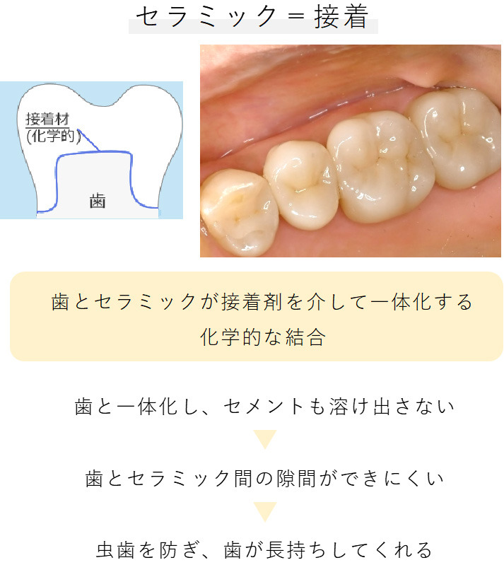 セラミック治療が良い治療である理由