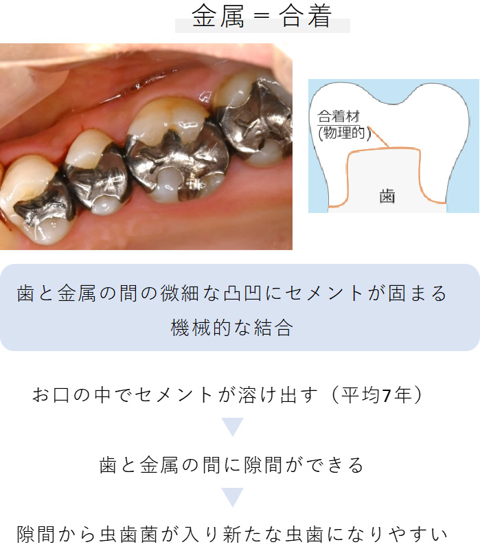 セラミック治療が良い治療である理由