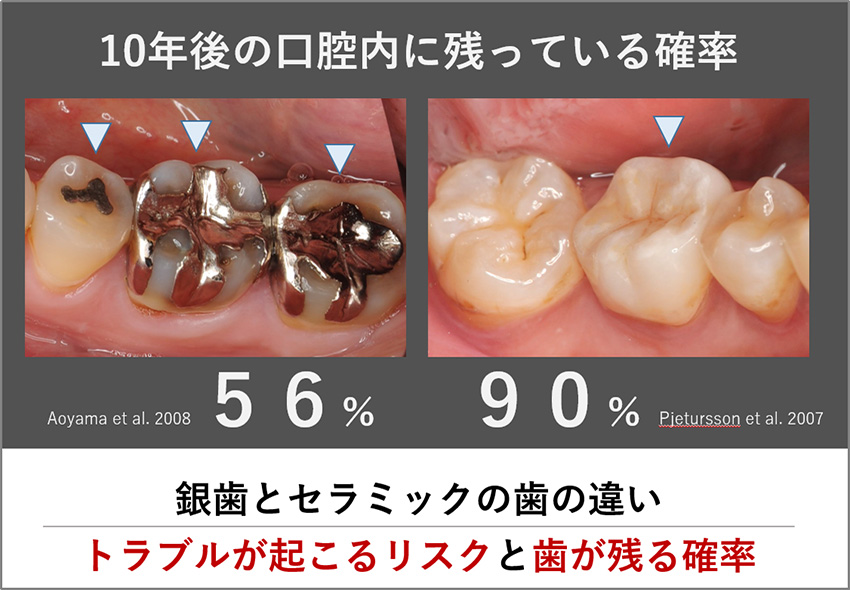 銀歯とセラミックだとどちらが長持ちする？