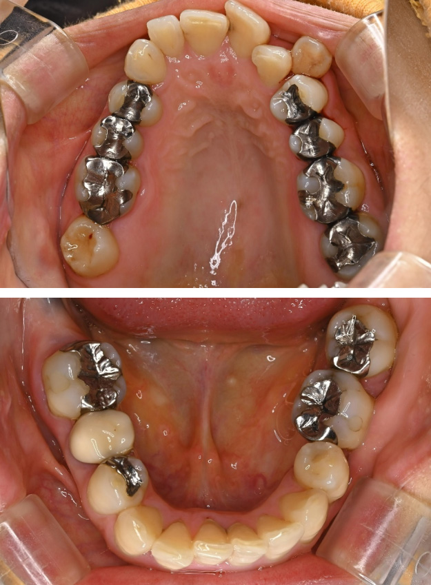 セラミックの症例2治療前