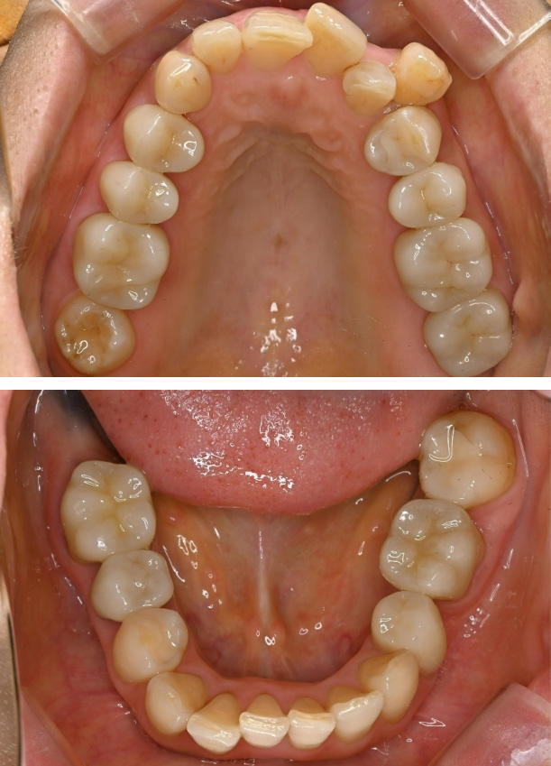 セラミックの症例2治療後