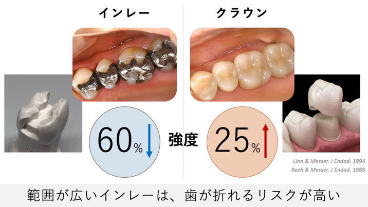 範囲が広いインレーは、歯が折れるリスクが高い