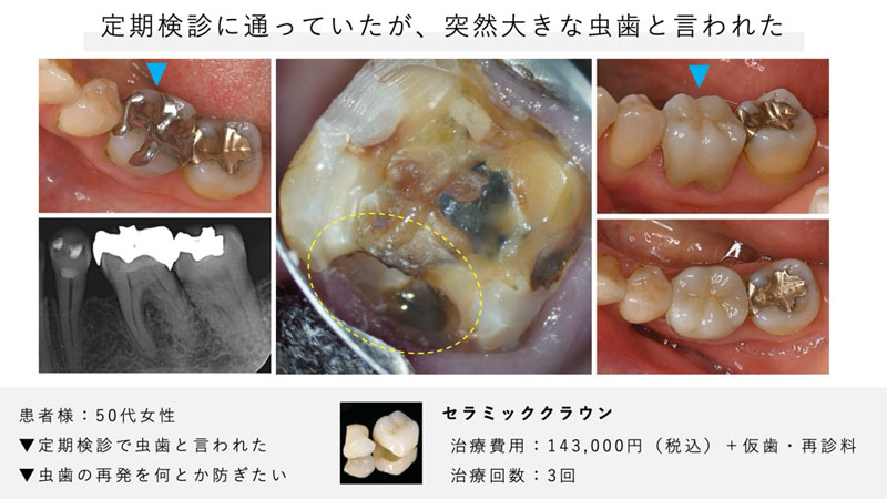 定期検診に通っていたものの銀歯の中で虫歯が見つかり、治療が必要となった患者様