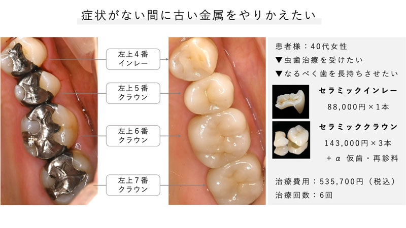 症状はないが、将来を見越して古い金属のやり直しを希望した患者様
