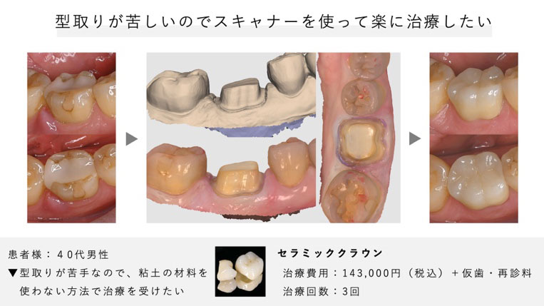 粘土の型取りが苦手なため、デジタルによる楽な方法で治療を希望し来院した患者様
