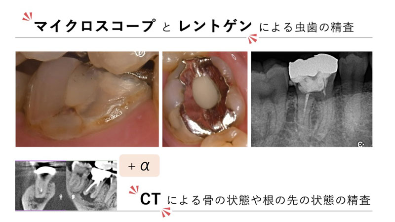 マイクロスコープとレントゲンによる虫歯の精査