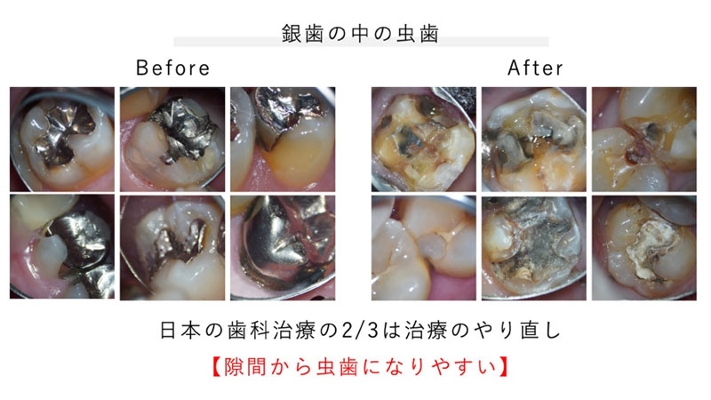 銀歯の中の虫歯