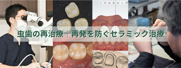 虫歯の再治療｜再発を防ぐセラミック治療