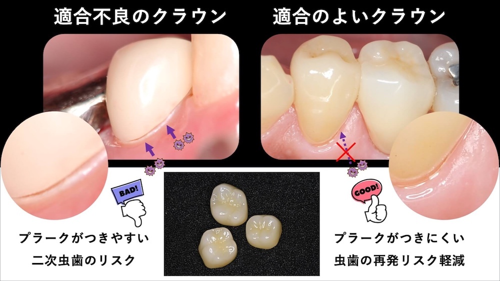 精密診断・ミクロン単位の精度を追求した再治療を防ぐ治療