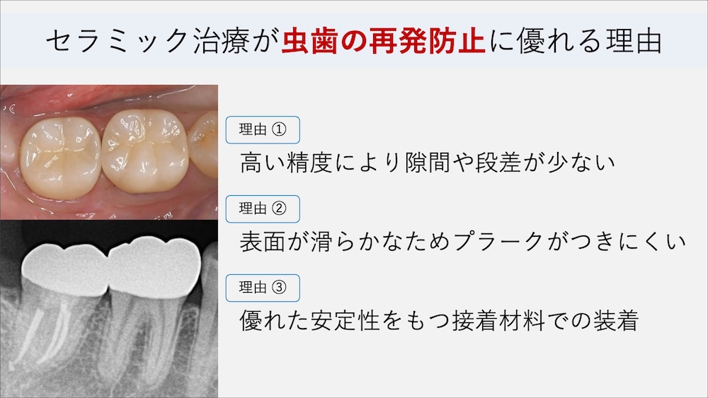 セラミック治療が虫歯の再発防止になる理由