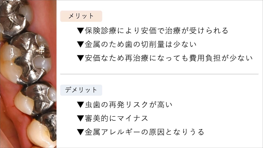 銀歯の特徴