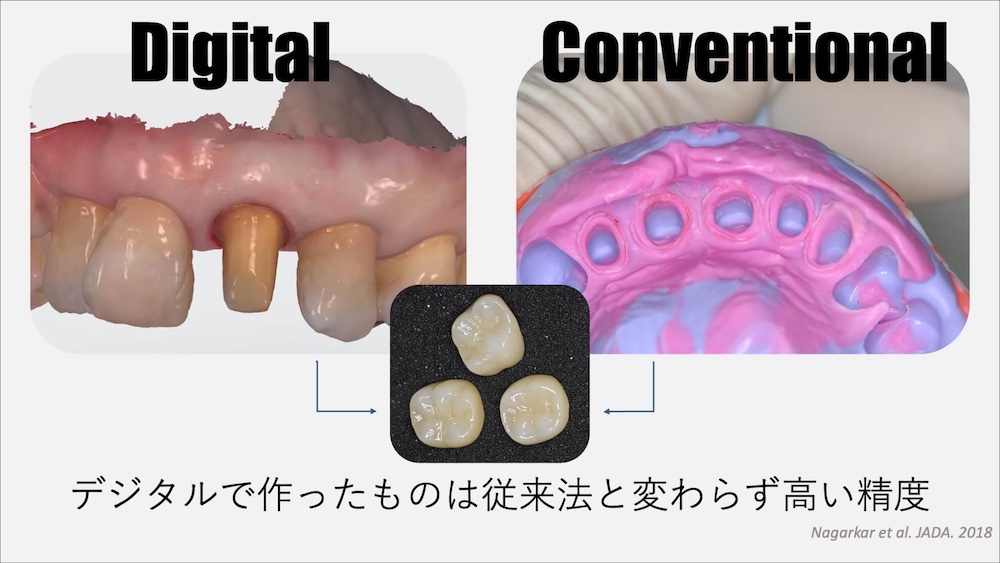 デジタルで作ったクラウンはしっかり適合するのか？