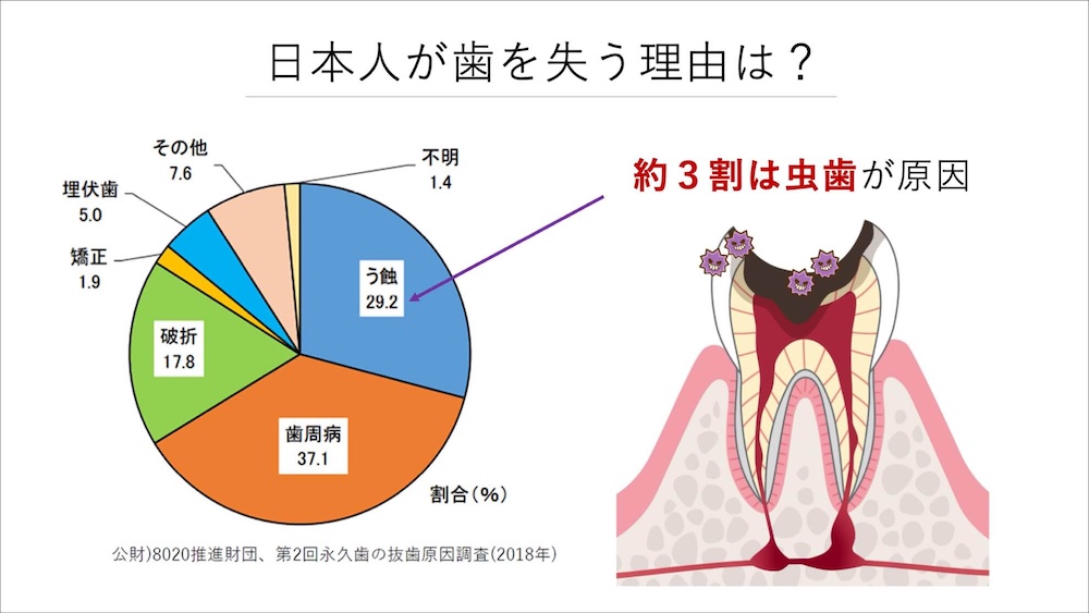 日本人が歯を失う理由のグラフ