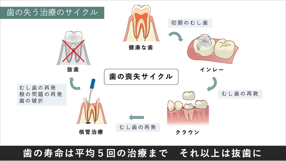 歯の寿命は基本的には平均5回治療するまで。