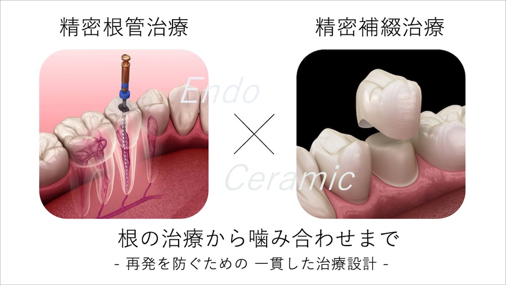 根管治療専門医だからこそできる、根の治療からクラウンまで“一歯単位でのベストな治療”