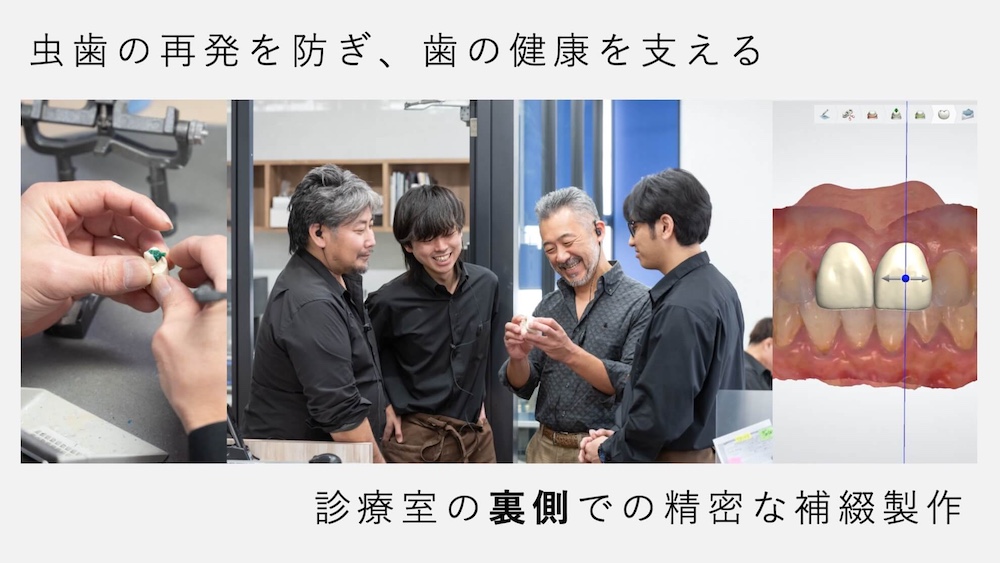 熟練の技工 × 緻密な設計による“長持ちするクラウン”の提供