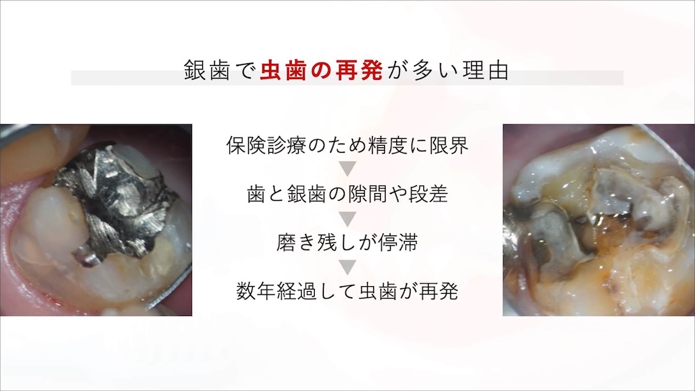銀歯で虫歯の再発が多い理由