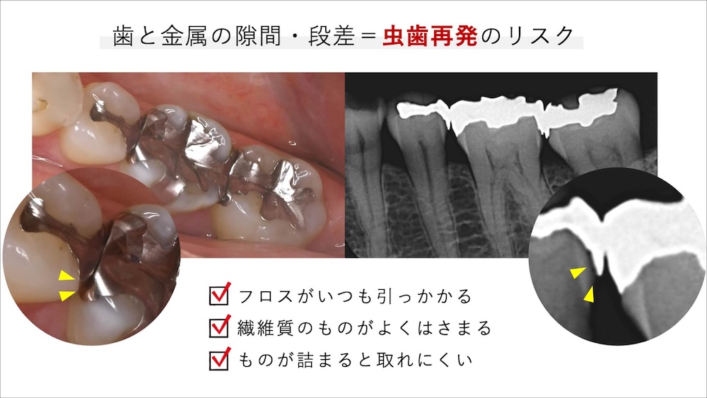歯と金属の隙間・段差＝虫歯再発のリスク