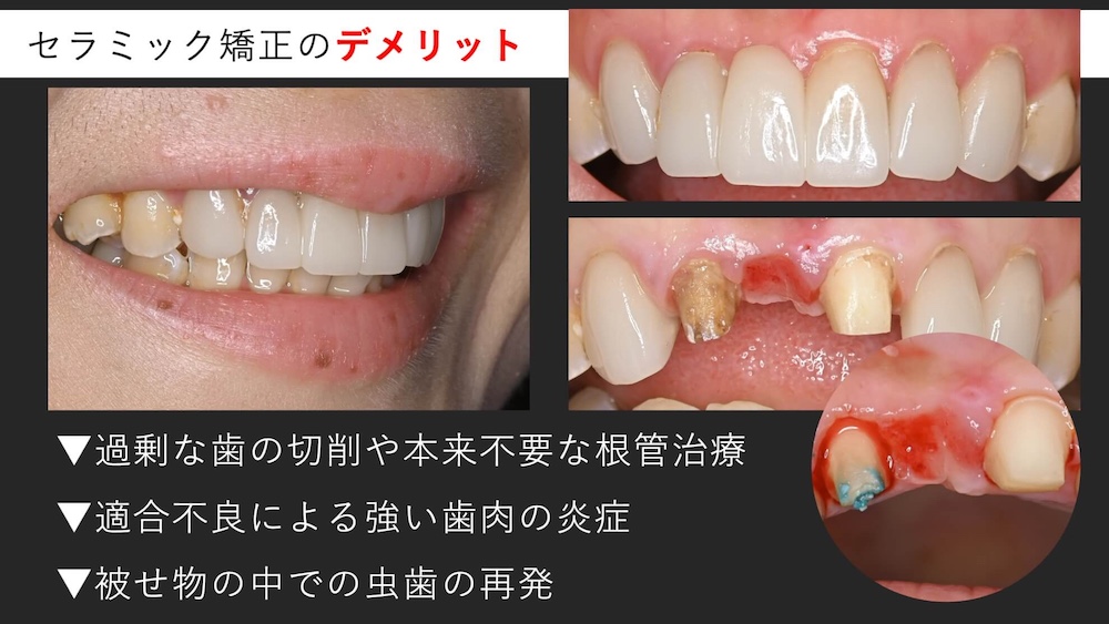 セラミック矯正のデメリット