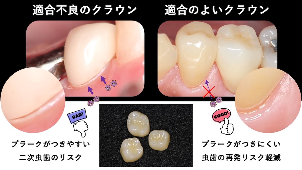 適合不良のクラウンはプラークがつきやすく二次虫歯のリスクが高い、適合の良いクラウンはプラークがつきにくく虫歯の再発リスク軽減につながる