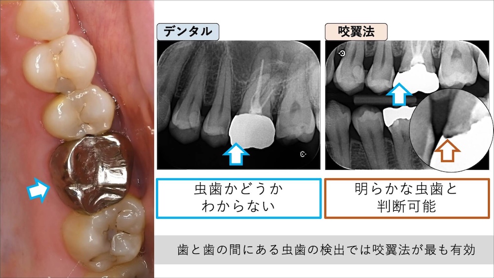 レントゲン画像での確認