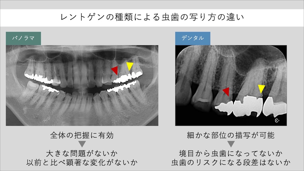 全体を写すレントゲンはあくまでスクリーニング