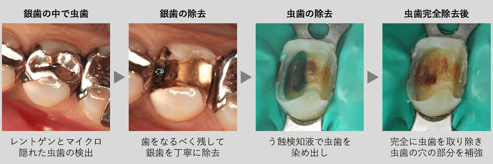 ②内部の虫歯を取り除き、神経を保護